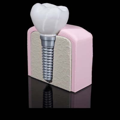 Dental Implant | 3D Printer Model Files